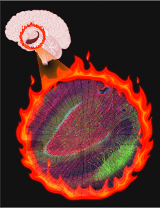 Altered cells create an electrical “fire” in patients with epilepsy. (BioRender illustration by Aswathy Ammothumkandy/Bonaguidi Lab/USC Stem Cell)